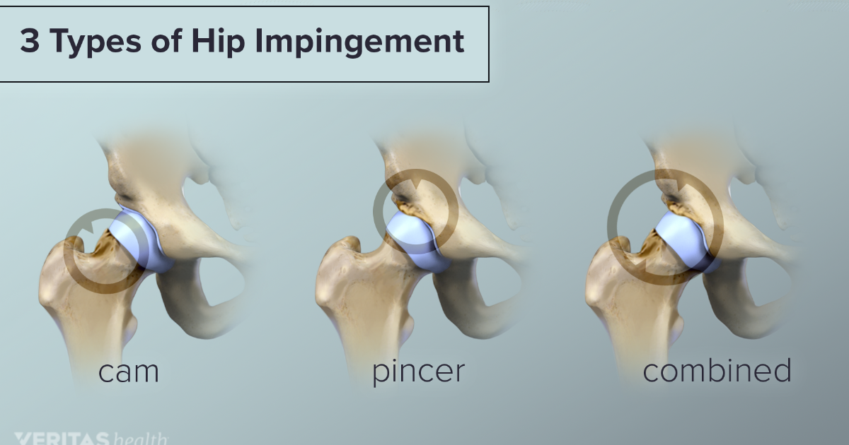 3 Types of Hip Impingement